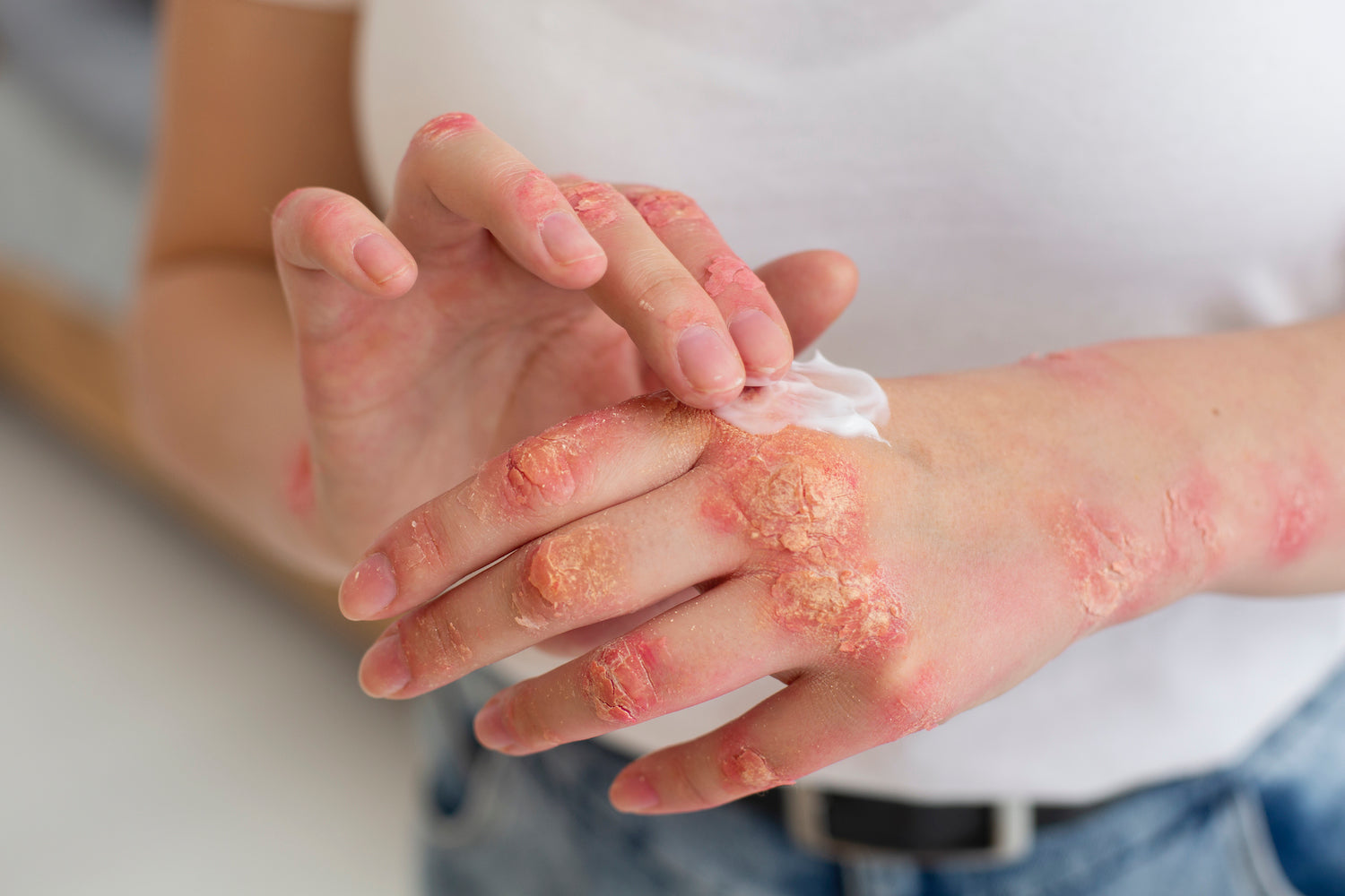 5 Benefits of Whipped Tallow for Eczema and Dry Skin